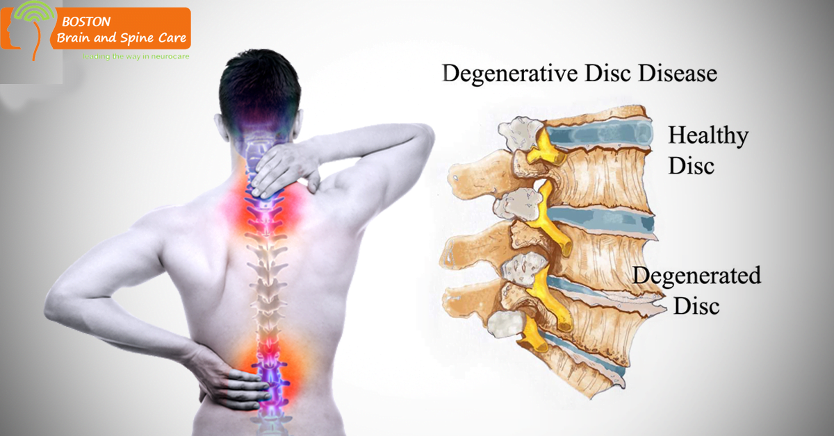 degenerative-disc-disease-or-disc-degeneration-boston-brain-and-spine